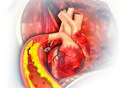 3-D illustration of a human heart with a clogged artery 
